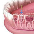 Yorkie root canal