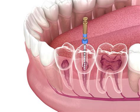 Yorkie root canal