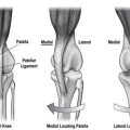 What is Yorkie patellar luxation