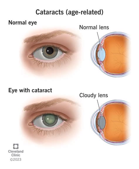 Why do Yorkies develop cataracts